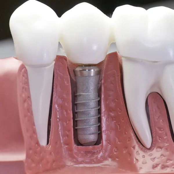 Dental implant close up cutaway