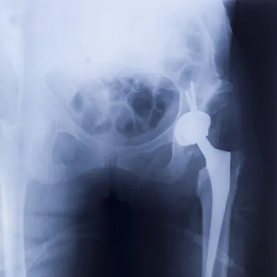 Hip implant x-ray