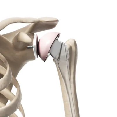 Shoulder implant on skeleton model