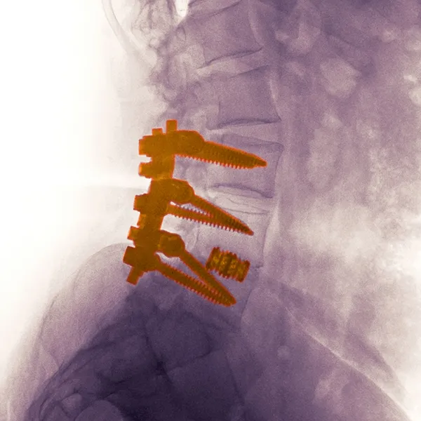 Spinal implant x-ray view