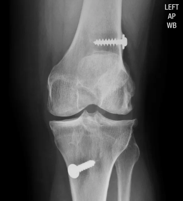 Bone Screw Implants