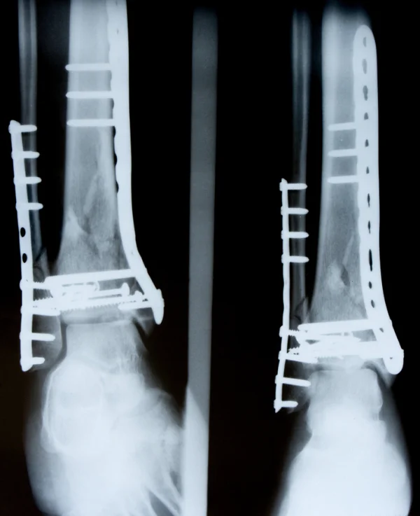 Bone Implants