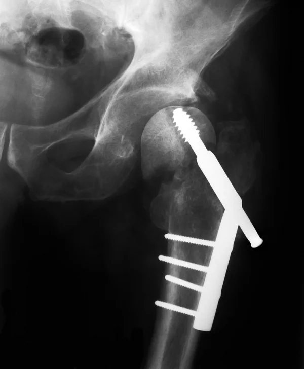 X-Ray Image of a Hip Implant
