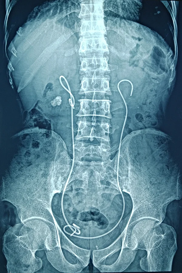 Implanted stent in X-ray image